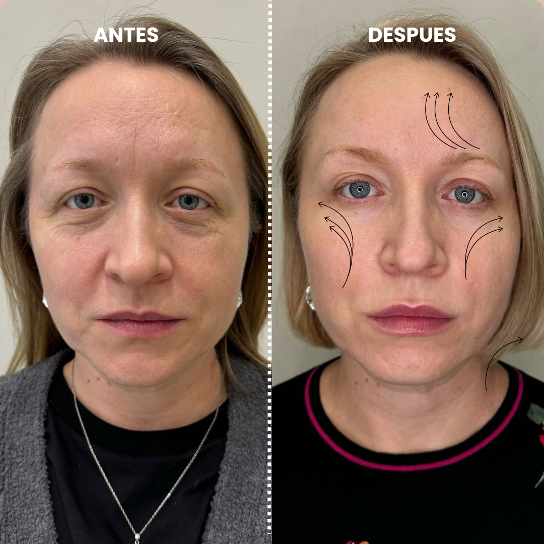 Lyra® Face Lifting | Redefiní tu rostro en 10 segundos