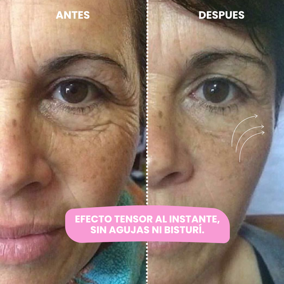 Lyra® Face Lifting | Redefiní tu rostro en 10 segundos